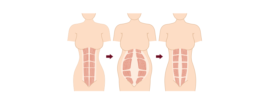 REPAIRING ABDOMINAL SEPARATION