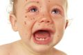 A baby boy with measles.