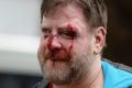 A Trump supporter is injured after sides clash at a rally for President Donald Trump in Berkeley, California on Saturday.