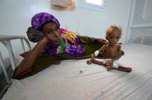 A woman rests on a bed next to her malnourished son at a hospital in the Red Sea port city of Houdieda, Yemen.  Meanwhile, a U.S. Navy-backed blockade of Yemen’s ports has left much of the country, the poorest in the Arab world, “on the brink of famine. Reuters