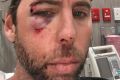 Grant Hackett posted an image of himself to social media, his face bloody and bruised.