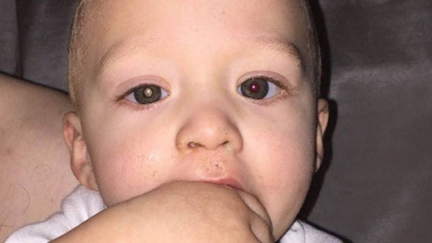 The eye on the left (his right eye) is shown with the 'glow' that indicated a problem with Jaxson's eye.