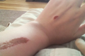 The "eraser challenge' causes serious burns and places students at risk of severe infection.