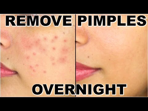 How To Remove Pimples Overnight | Acne Treatment | ShrutiArjunAnand