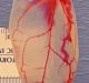 The scientists seeded the gaps in the plant cells with human heart tissue and fed red dye through it after watching ...