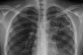 "There was not an outbreak of tuberculosis in October in Sydney": Health authorities insist. 