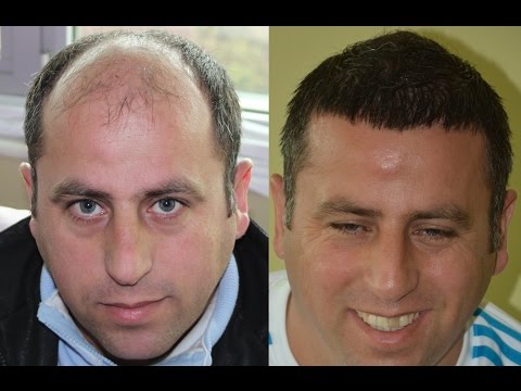 Hair Transplant Before and After Images | 8384 Grafts |  (2Years) NW 6