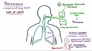 File:Pneumonia.webm