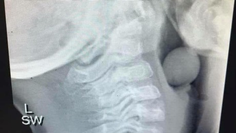 This x-ray image shows how easily a grape can block a child's airways.