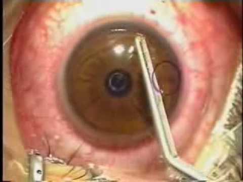 Lasik Laser Eye Surgery Procedure - Live Surgery