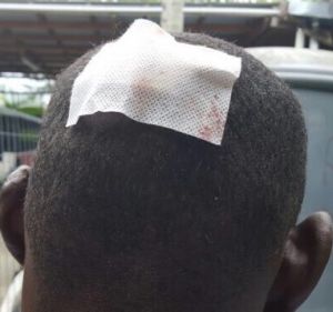 A Sudanese refugee received stitches after being hit by rock.