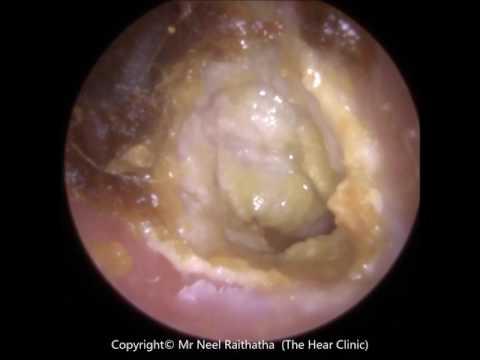 194:   Eardrum about to 'POP' revealed after Ear Wax Removal - Mr Neel Raithatha (THC)