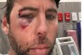 Grant Hackett posted an image of himself to social media on Thursday, his face bloody and bruised.