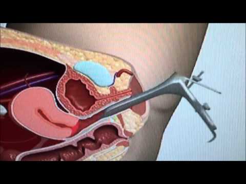 Pap Test  - Procedure