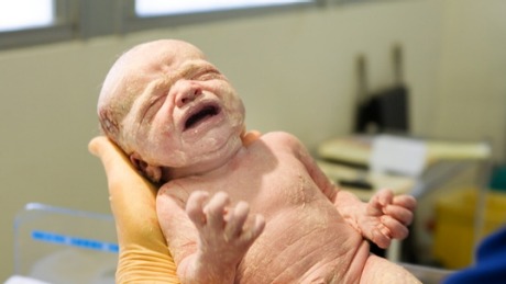 Some babies are born with a protective covering of vernix.