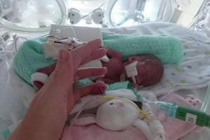 Abi Peters is the youngest patient to survive major abdominal surgery, after she was born at 23 weeks gestation.