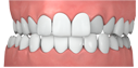 Bite crossbite 0bd4001c482593d6f449d017d9ae87ea789988d15b381e4e2d7e08f207498625