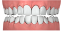 Bite crowded 124f660de45c529d36d88d392744e078158f08a5cae62e5b5bf85d7590336301