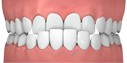 Bite underbite 68673f1730dcaddc04778afd5d21b08f4c87944627a03ff96a85a09c403dde72