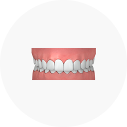 Bite overbite cir 59fdb37b4c6bae14895856c279f6b3e193ed1aba1f73c216dedf3b805cf8f51e