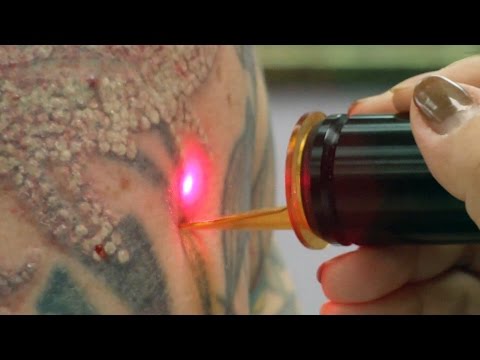 Laser Tattoo Removal - How a Tattoo is Removed