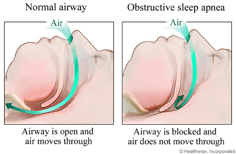 Sleep Apnea