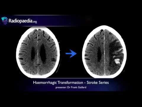 Stroke: Haemorrhagic transformation - radiology video tutorial (CT, MRI)