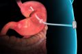 The AspireAssist system consists of a thin tube implanted in the stomach, connecting to an outside port on the skin of ...