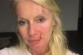 Shari Lea Hitchcock posted a photograph on Instagram, claiming she was assaulted.