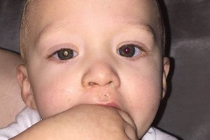 The eye on the left (his right eye) is shown with the 'glow' that indicated a problem with Jaxson's eye.