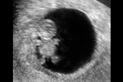 Possibly a gummy bear - scan at 6.5 weeks. (<a href="https://fiscafamily.wordpress.com/category/ultra-sound-images/">img</a>)