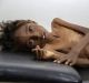 Five-year-old Mohannad Ali lies on a hospital bed in Abs, Yemen, in December. His two-year-old cousin died of hunger.