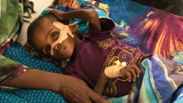 Niman Adan Gabush,2, is a severe malnutrition case at Hargeisa Group Hospital.