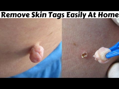 Top 5 Home Remedies To Remove Skin Tags | How To Remove Skin Tags Easily At Home