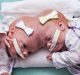 Conjoined twin girls Abby, right, and Erin at the Children's Hospital of Philadelphia in Philadelphia. 