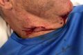 The injury that came within millimetres of Cam McIntyre's carotid artery.