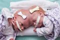 Conjoined twin girls Abby, right, and Erin at the Children's Hospital of Philadelphia in Philadelphia. 