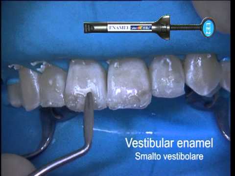 Enamel Plus HRi -kerrostusvideo. Dr. Lorenzo Vanini. ENA HRi. Kompodent