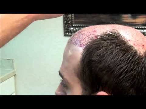 Hair Transplant Surgery