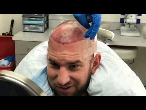 FUE Hair Transplant Surgery in Los Angeles - Best FUE Hair Restoration LA