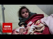 Saudi-Trump War on Yemen: Cholera Cases could Reach 130,000 in Two Weeks