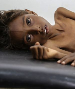 Five-year-old Mohannad Ali lies on a hospital bed in Abs, Yemen, in December. His two-year-old cousin died of hunger.