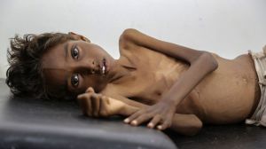 Five-year-old Mohannad Ali lies on a hospital bed in Abs, Yemen, in December. His two-year-old cousin died of hunger.