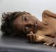 Five-year-old Mohannad Ali lies on a hospital bed in Abs, Yemen, in December. His two-year-old cousin died of hunger.