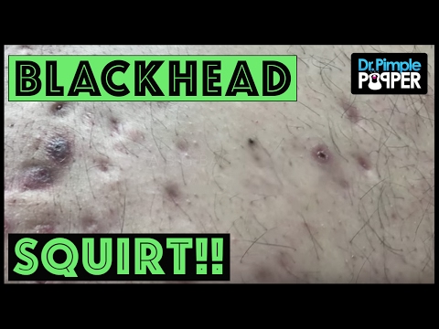 Back Blackheads Squirt onto my FACE!!