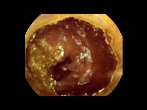 Pill Camera Swallowed - Follow Through Gut - Guts - Brit Lab - BBC