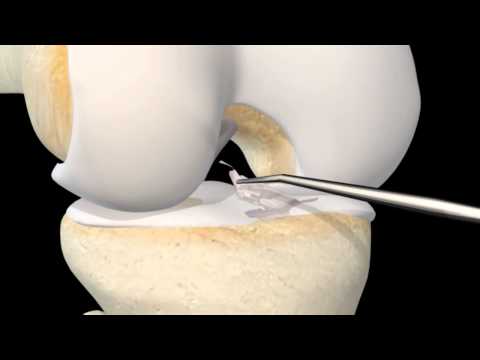 ACL Surgery - 3D Reconstruction