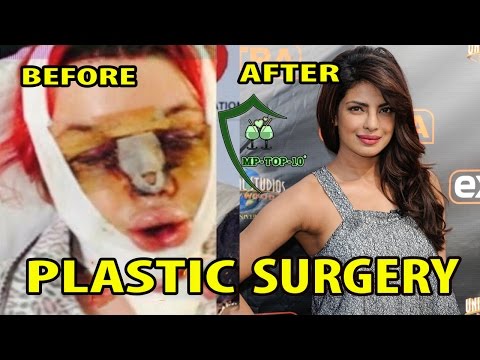 Top 10 Plastic Surgery Photos Of  Popular Bollywood Actresses -  BEFORE & AFTER