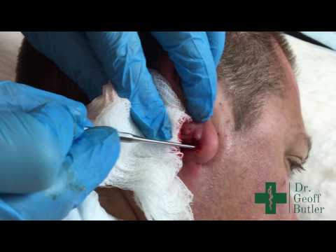 Drainage of Infected Epidermal Cyst Lobule of Ear