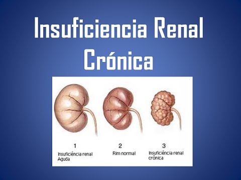 Insuficiencia Renal Cronica - IRC